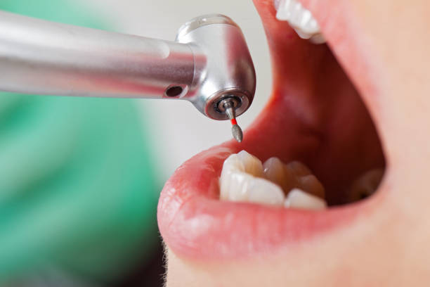 Best Emergency Root Canal Therapy in Resaca, GA
